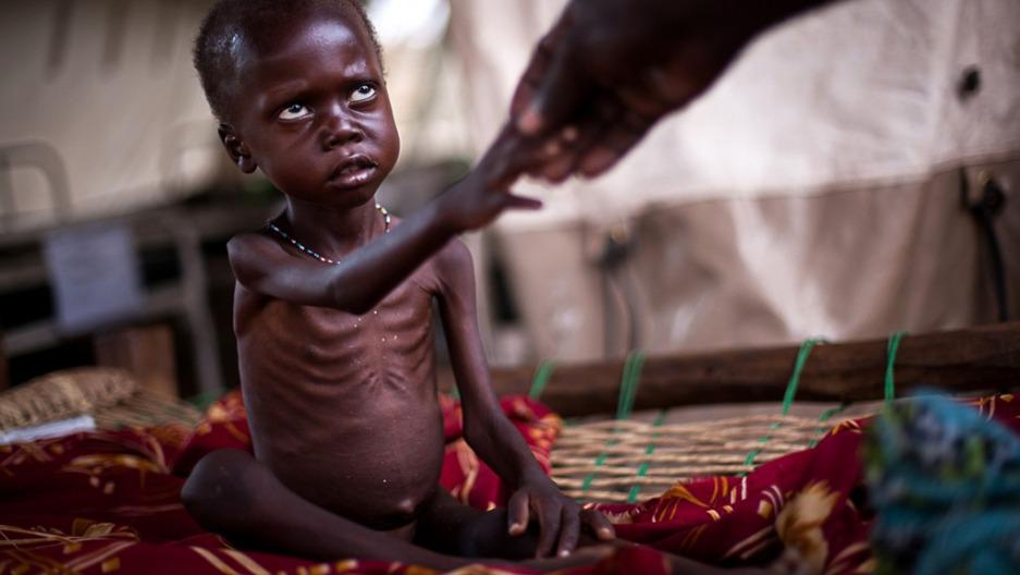 starving child - famine in Somalia